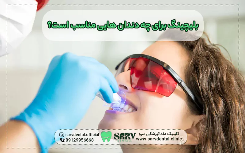 بلیچینگ برای چه دندان هایی مناسب است؟