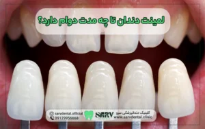 لمینت دندان تا چه مدت دوام دارد؟