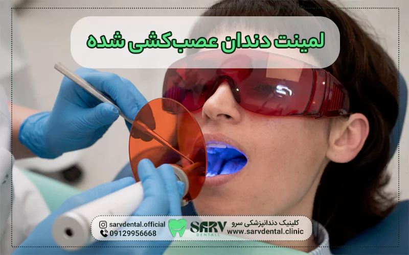 لمینت برای دندان عصب کشی شده