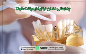 چه زمانی دندان نیاز به ایمپلنت دارد؟