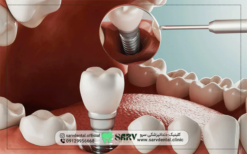 انواع ایمپلنت دندان و قیمت هر کدام