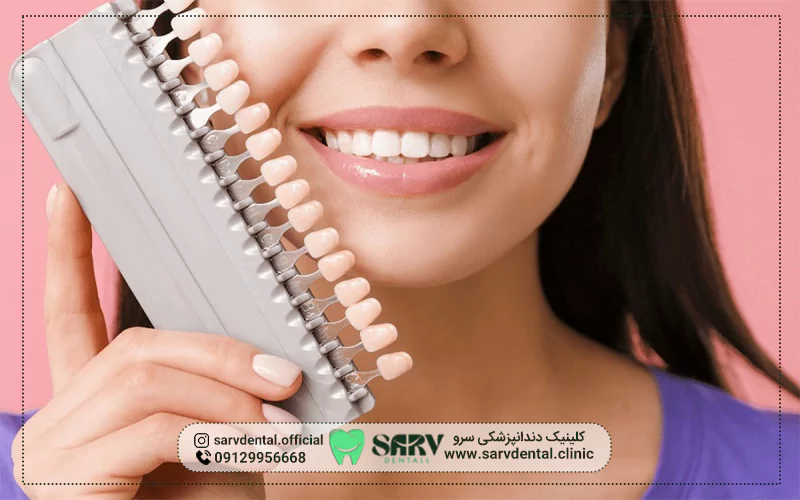 قیمت لمینت در بهترین کلینیک