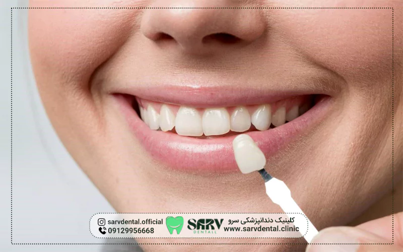 عوامل مؤثر بر قیمت لمینت دندان چیست؟