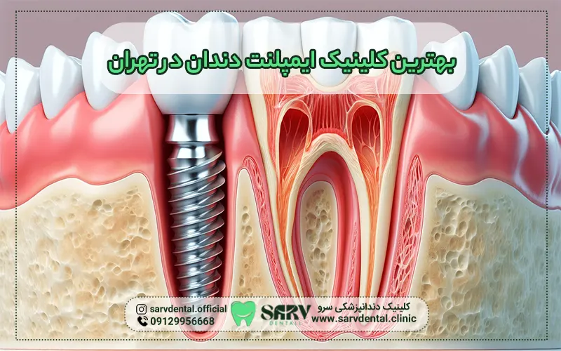 بهترین کلینیک ایمپلنت دندان در تهران