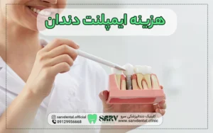 قیمت ایمپلنت دندان