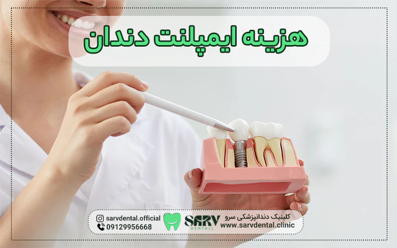 قیمت ایمپلنت دندان