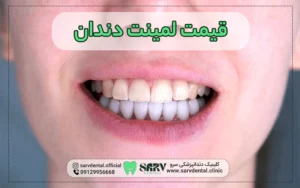 قیمت لمینت دندان