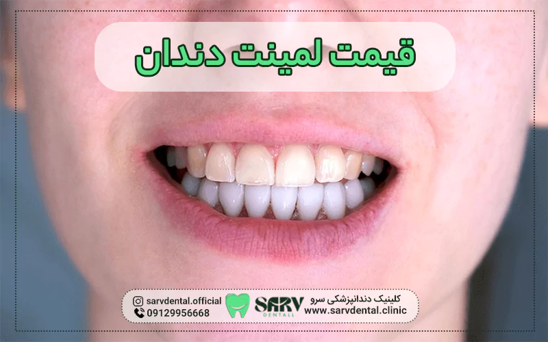 قیمت لمینت دندان