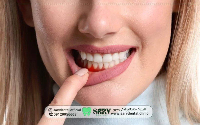 آشنایی با لمینت دندان