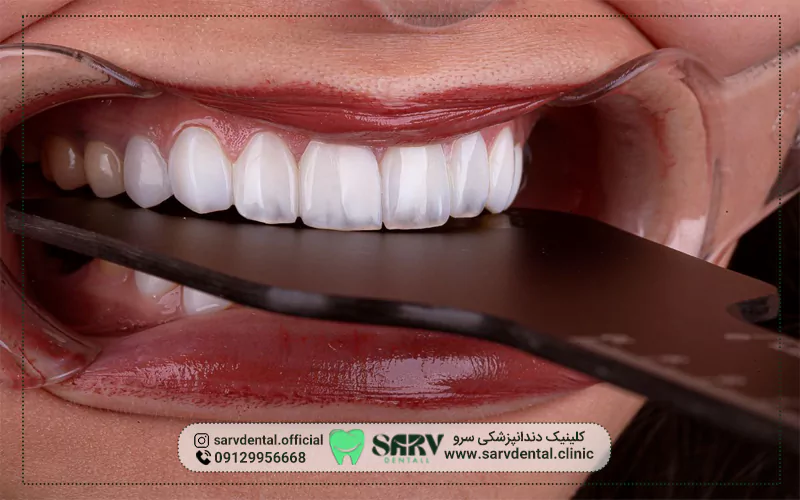 چه زمانی باید لمینت دندان را تعویض کرد؟