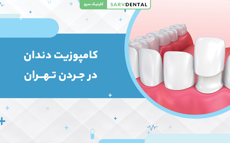 کامپوزیت دندان در کلینیک دندانپزشکی سرو جردن تهران