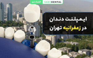 ایمپلنت دندان در زعفرانیه تهران