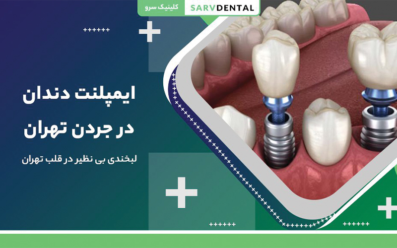 dental implant jordan tehran 1