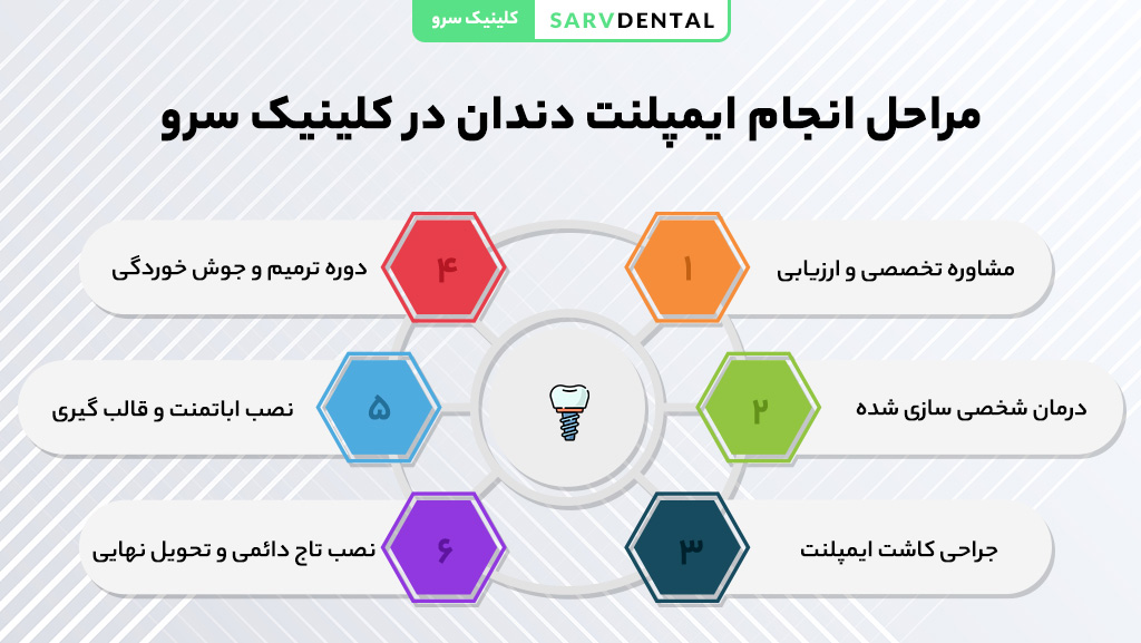 مراحل انجام ایمپلنت دندان در کلینیک سرو
