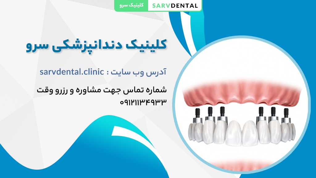 بهترین ایمپلنت دندان در کلینیک دندانپزشکی سرو