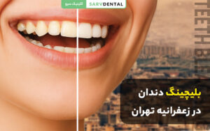 بلیچینگ دندان در زعفرانیه تهران برای سفید کردن دندان‌ها