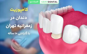 کامپوزیت دندان با کیفیت در زعفرانیه تهران
