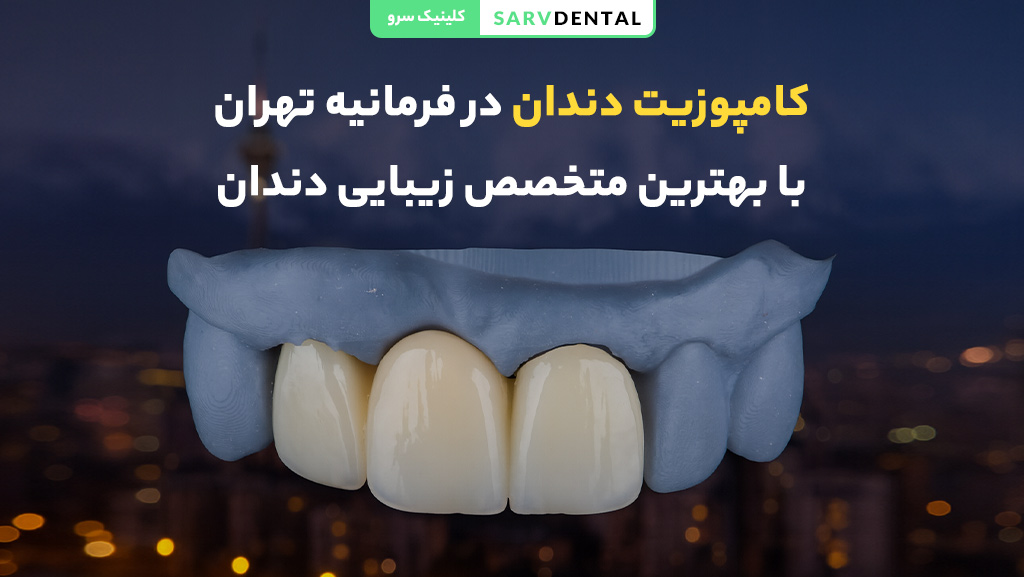 کامپوزیت دندان در فرمانیه تهران با بهترین کیفیت و ماندگاری