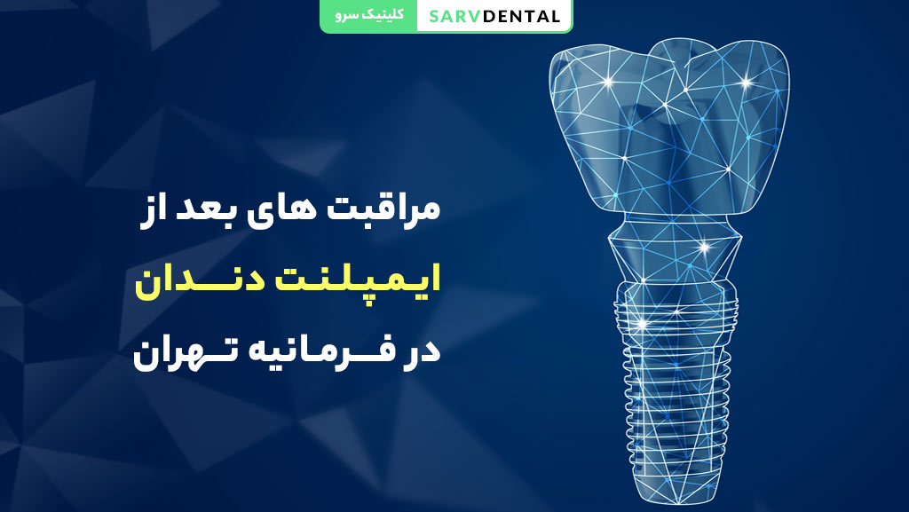 مراقبت های بعد از ایمپلنت دندان