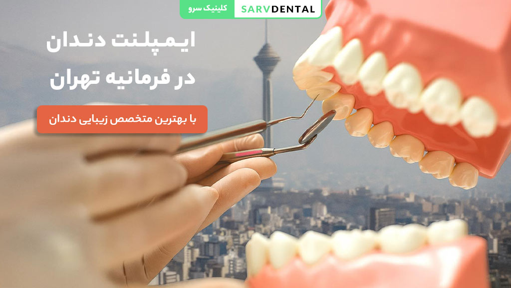 ایمپلنت دندان در فرمانیه تهران با بهترین متخصص