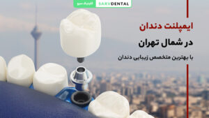 ایمپلنت دندان در شمال تهران در کلینیک سرو