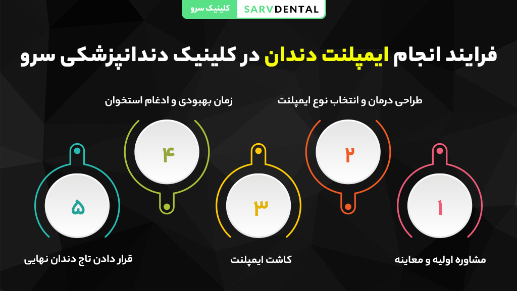 مراحل انجام ایمپلنت دندان