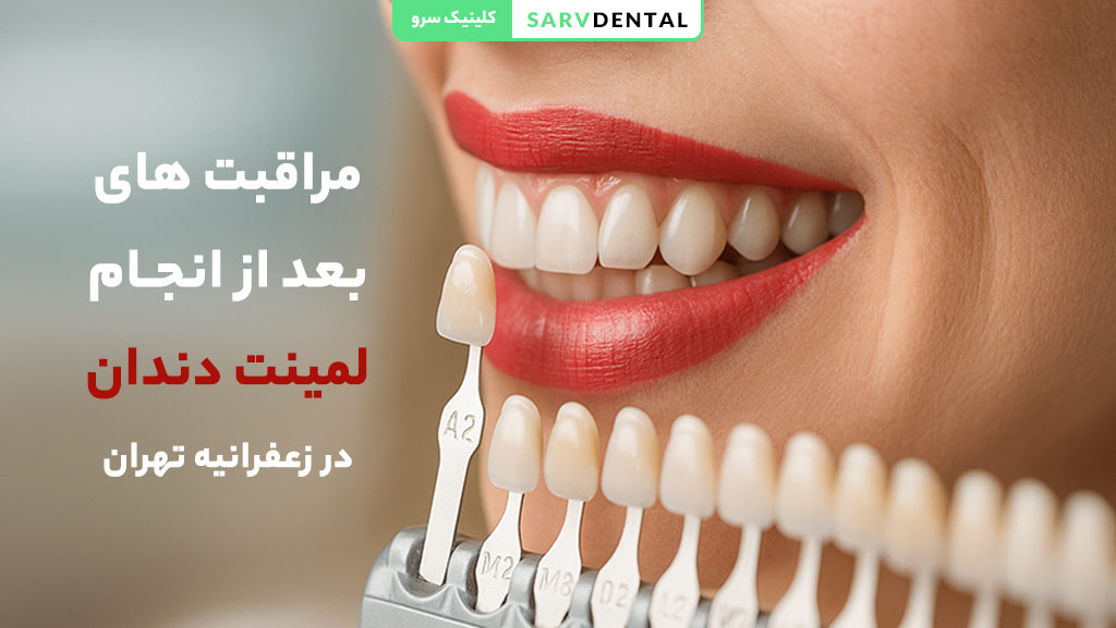 مراقبت‌های بعد از لمینت دندان