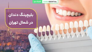 بلیچینگ دندان حرفه‌ای در شمال تهران با بهترین دندانپزشک