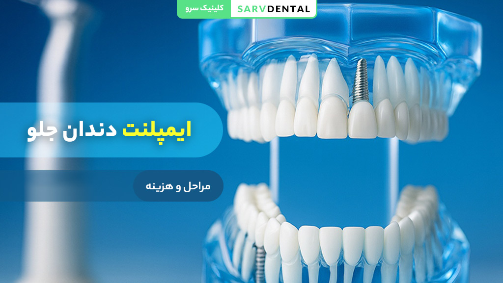 ایمپلنت دندان جلو چیست و چه کاربردی دارد