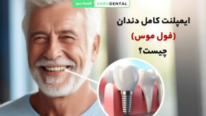 ایمپلنت کامل دندان (فول موس) چیست