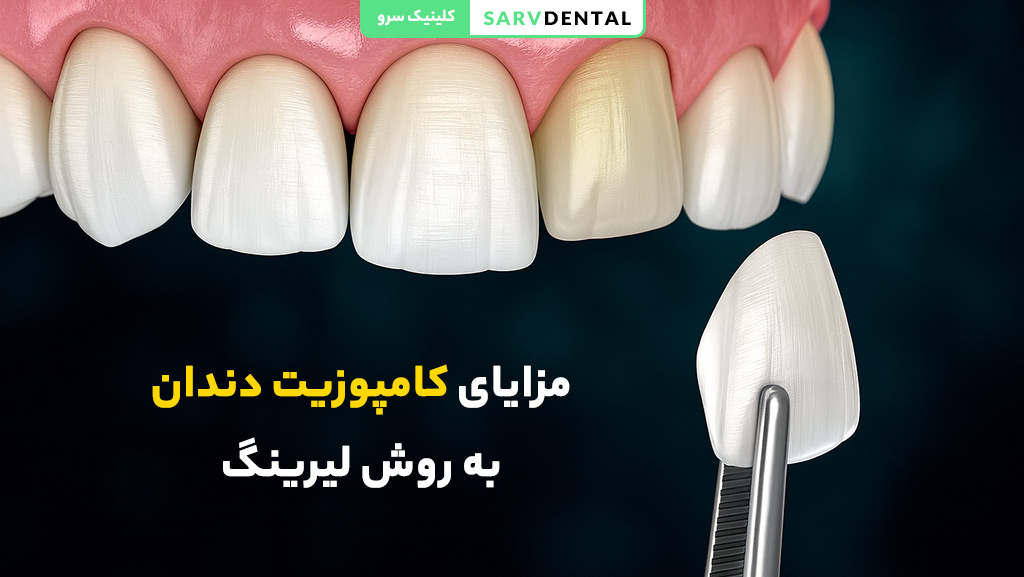 فواید کامپوزیت دندان به روش لیرینگ
