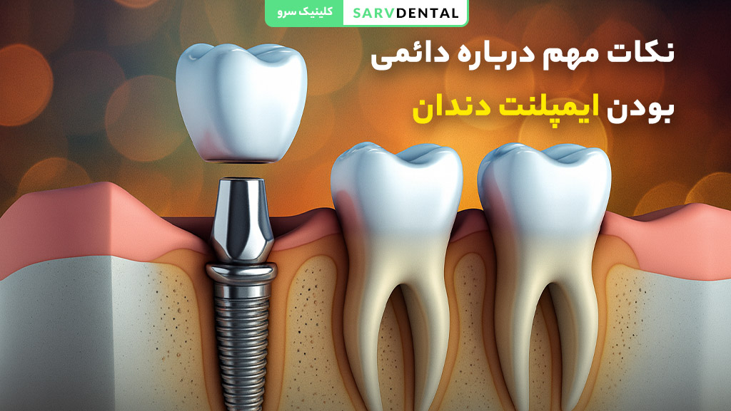 راهکارهای افزایش عمر ایمپلنت