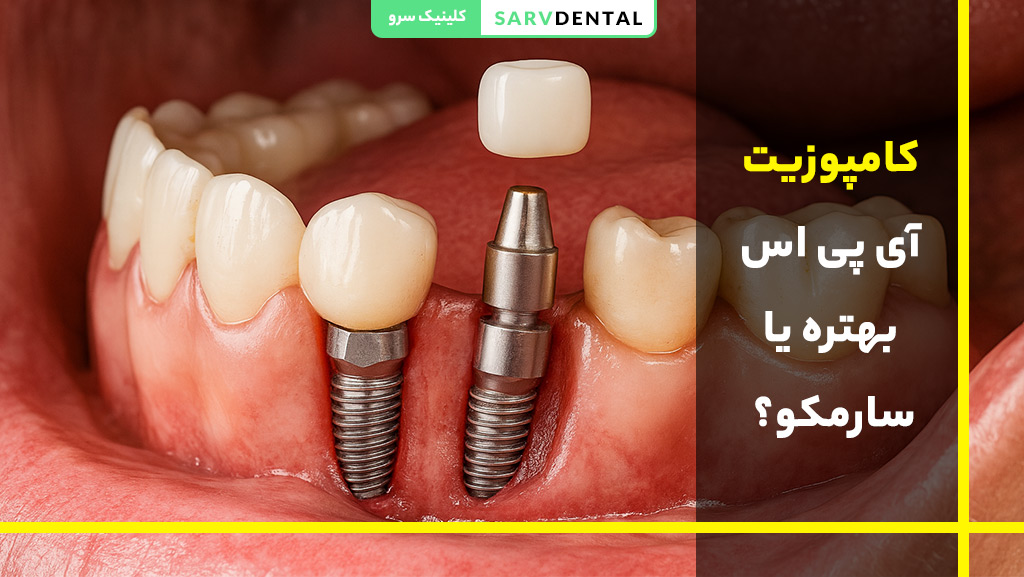 مقایسه کامپوزیت آی پی اس و سارمکو