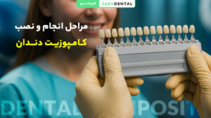 مراحل نصب و انجام کامپوزیت دندان توسط دندانپزشک متخصص در کلینیک زیبایی