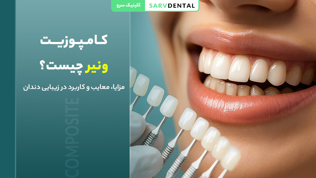 کامپوزیت ونیر چیست و چه کاربردی دارد در زیبایی دندان‌ها