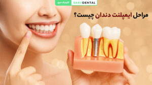 مراحل ایمپلنت دندان به صورت کامل و تصویری در کلینیک دندانپزشکی سرو