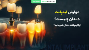 مشکلات رایج بعد از کاشت ایمپلنت