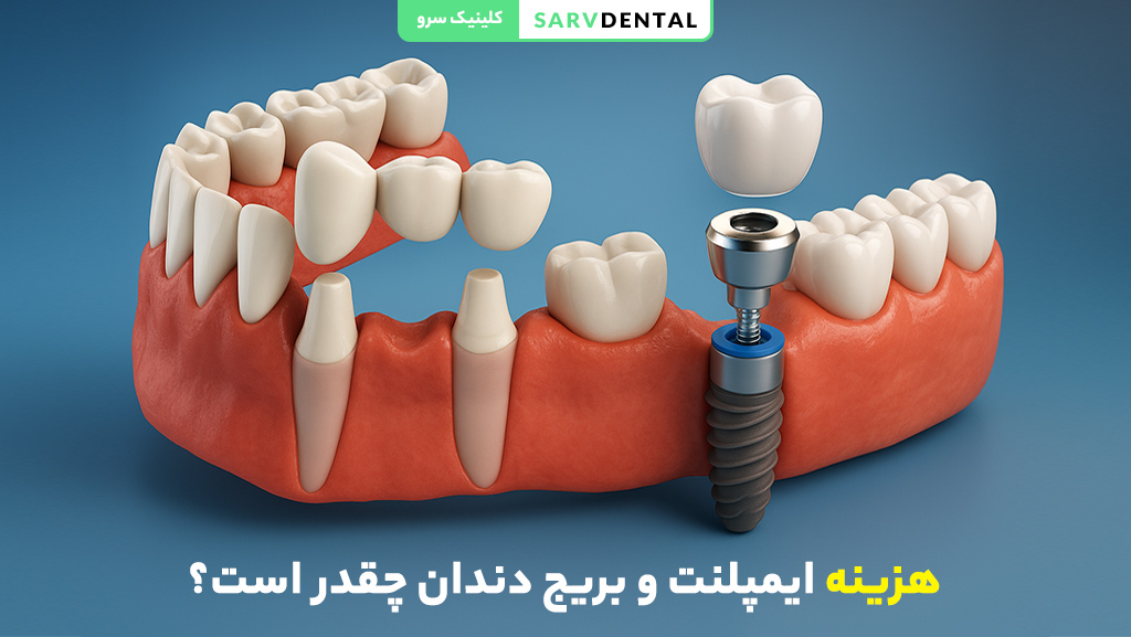 هزینه ایمپلنت و بریج دندان | قیمت مقایسه ایمپلنت و بریج