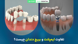 تفاوت ایمپلنت و بریج دندان