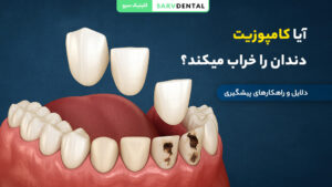 آیا کامپوزیت دندان باعث خرابی دندان می‌شود؟ بررسی تاثیر کامپوزیت روی سلامت دندان
