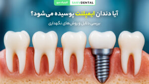 آیا ایمپلنت دندان پوسیده می‌شود؟ بررسی علت‌ها و پیشگیری از پوسیدگی ایمپلنت