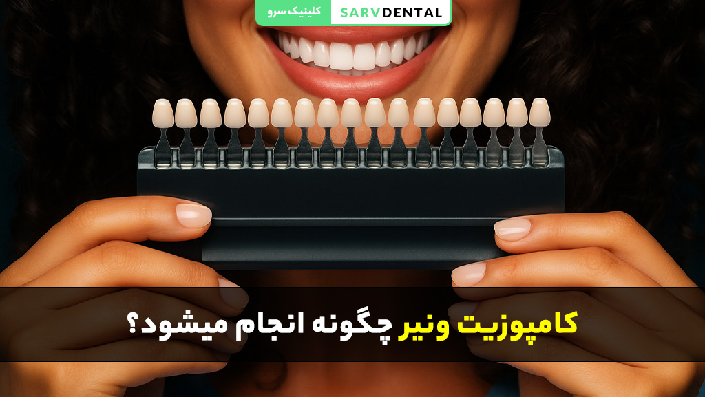 مراحل انجام ونیر کامپوزیت دندان به صورت تخصصی