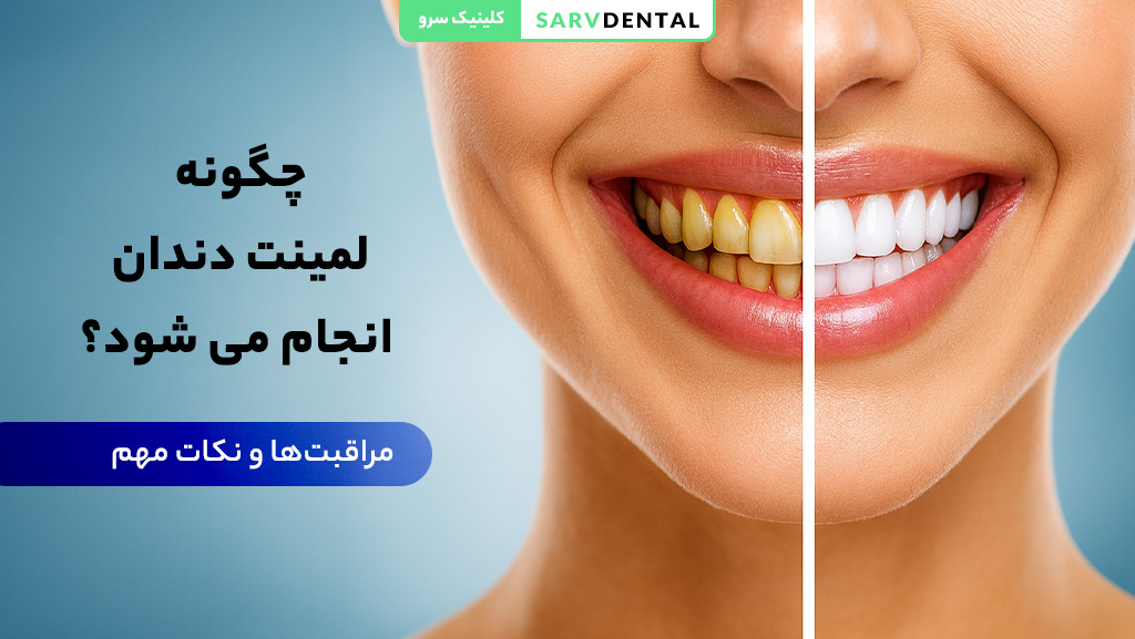 مراحل انجام لمینت دندان به صورت مرحله به مرحله
