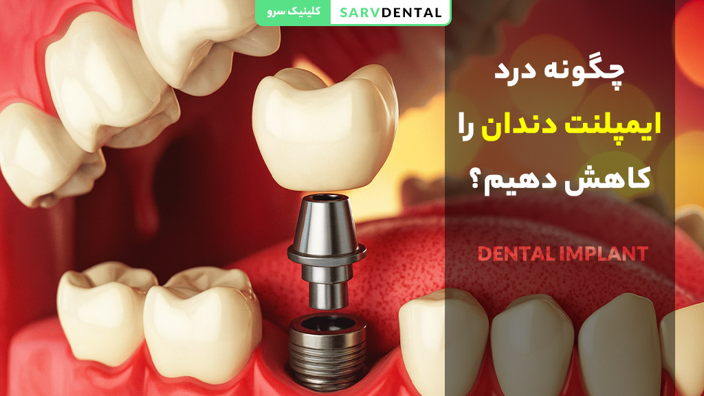 چگونه درد ایمپلنت دندان را کاهش دهیم؟ راهکارهای کاهش درد بعد از ایمپلنت دندان