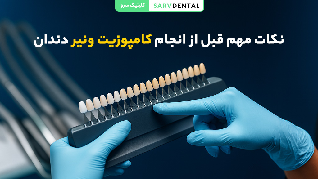 توصیه‌های ضروری پیش از ونیر کامپوزیت