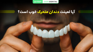 بررسی مزایا و معایب لمینت متحرک دندان