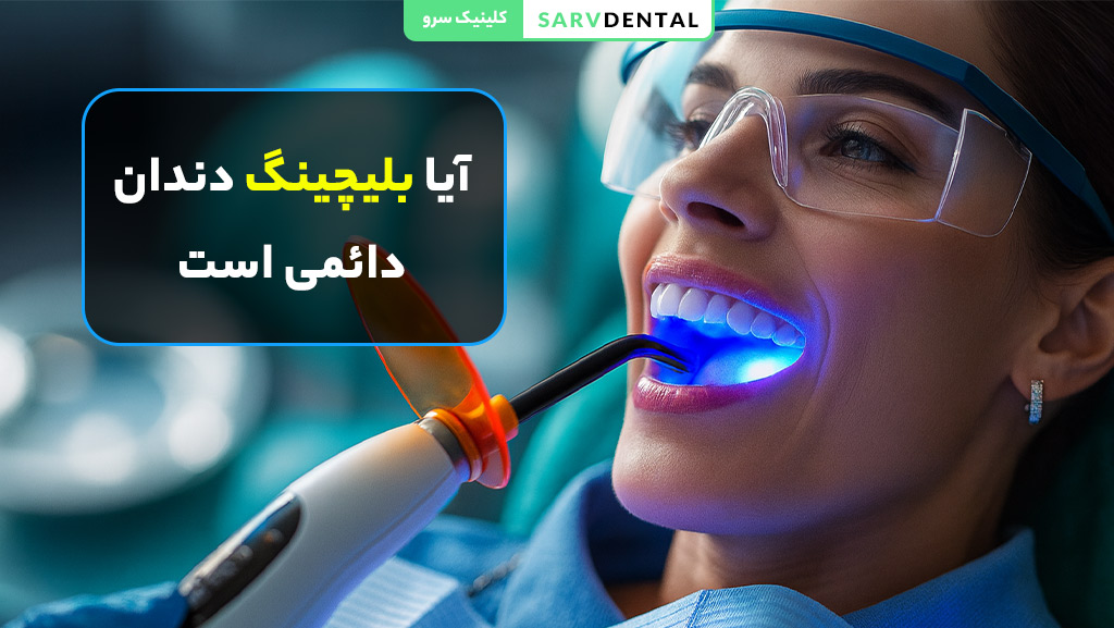 آیا بلیچینگ دندان دائمی است؟ بررسی ماندگاری و طول عمر سفید کردن دندان