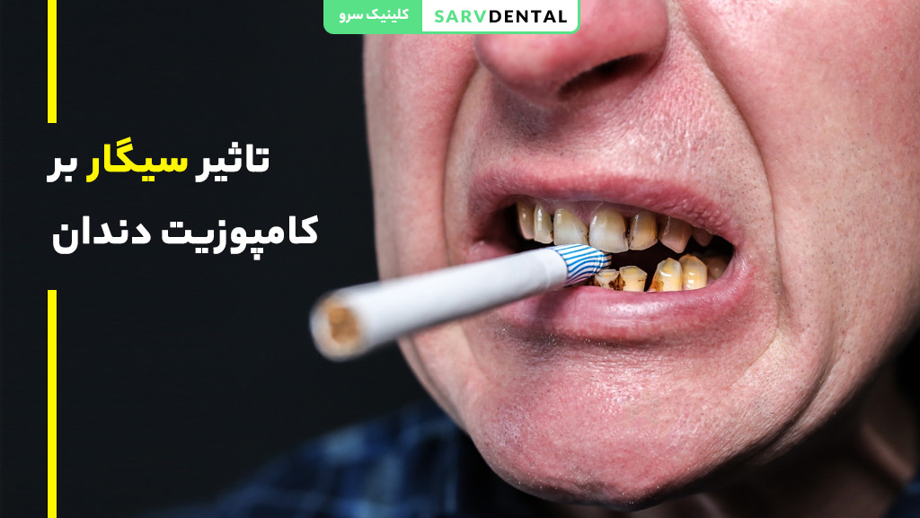 تاثیر سیگار بر کامپوزیت دندان و تغییر رنگ آن