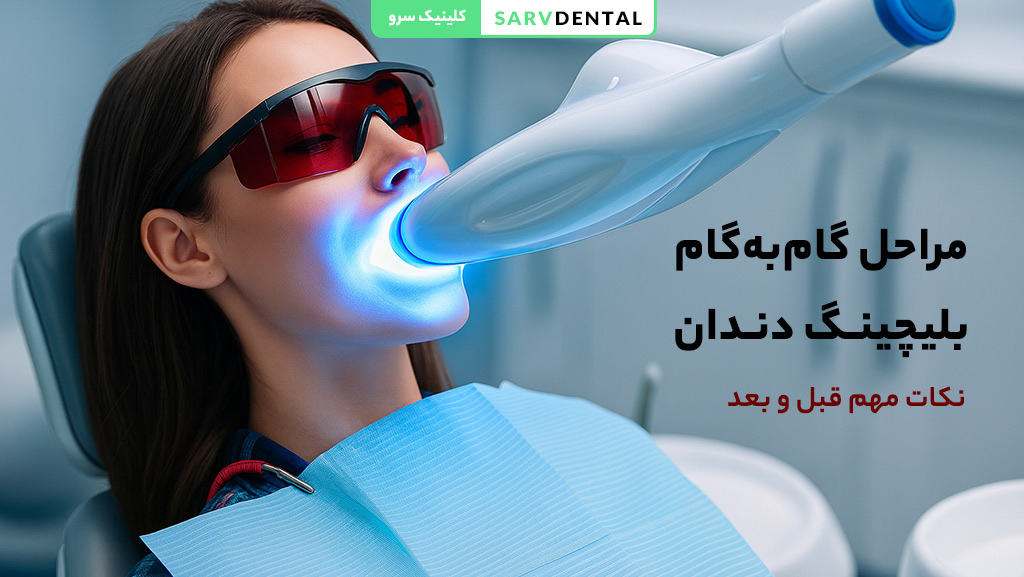 مراحل گام به گام بلیچینگ دندان در کلینیک دندانپزشکی