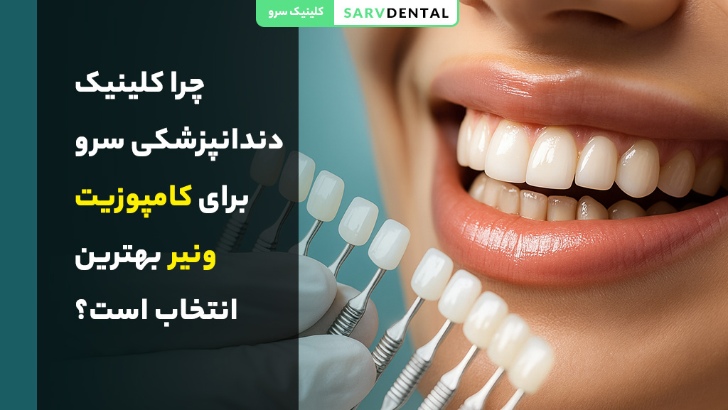 کامپوزیت ونیر چیست و چه کاربردی دارد در زیبایی دندان‌ها